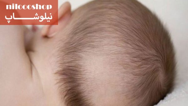 ریزش مو ناشی از کم خونی در کودکان